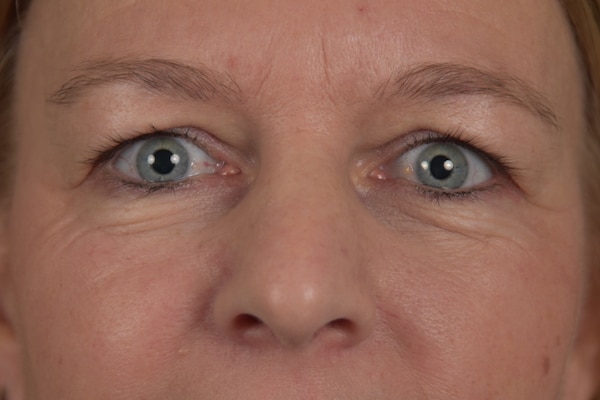 Maastricht-mooi-kliniek-ooglidcorrectie