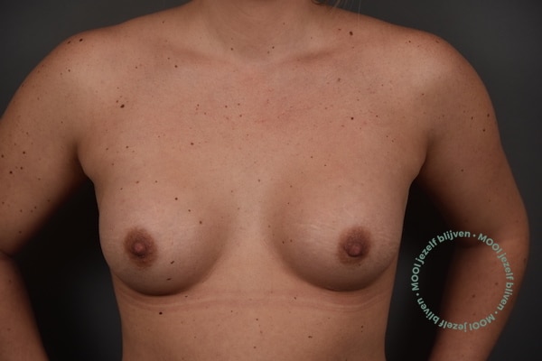 borstvergroting-235-cc