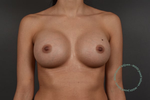 borstvergroting-400-cc-mooi