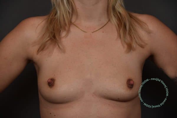 borstvergroting-foto-voor