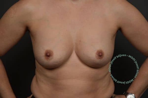 borstvergroting eigen met foto