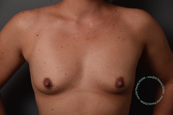 borstvergroting-na-zwangerschap