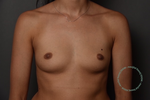 borstvergroting-voor-foto