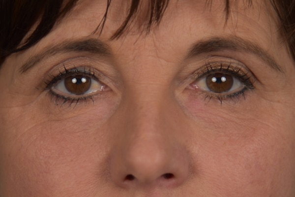 dubbele-ooglidcorrectie