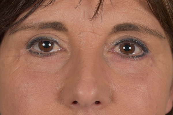 hangende-oogleden-verwijderen