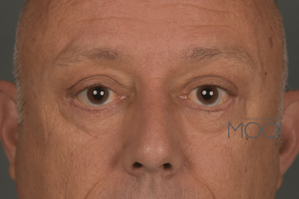 ooglidcorrectie man foto