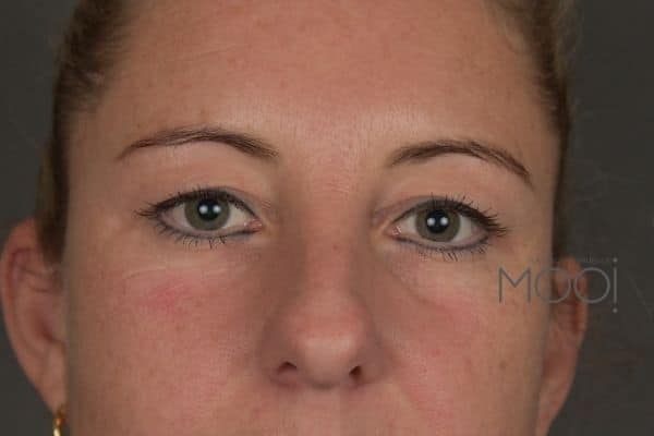 ooglidcorrectie-jonge-vrouw