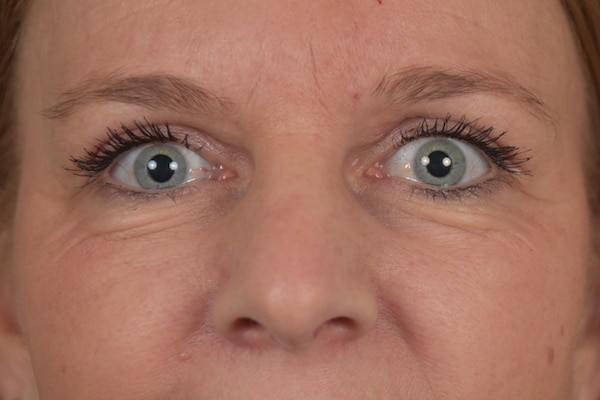 ooglidcorrectie-maastricht-voorbeeld