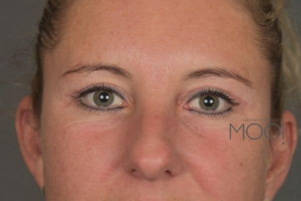ooglidcorrectie-resultaat-jonge-vrouw