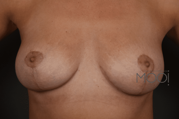 voor-en-na-borstlift-foto