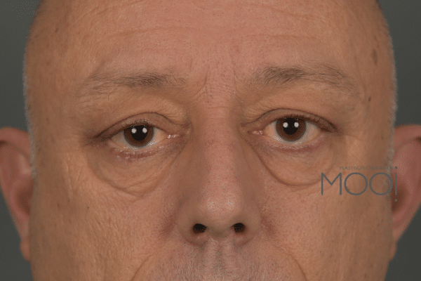 voor-foto-ooglidcorrectie