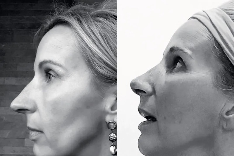 voor en na foto neuscorrectie