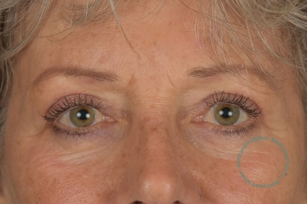 Bovenooglidcorrectie resultaten