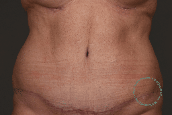 Buikwandcorrectie na foto