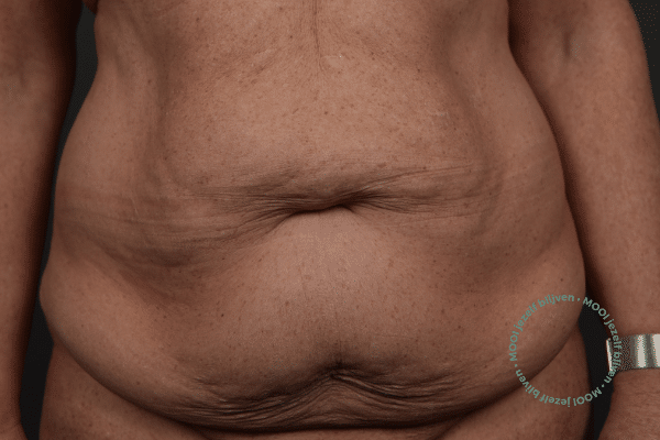 Buikwandcorrectie voor foto