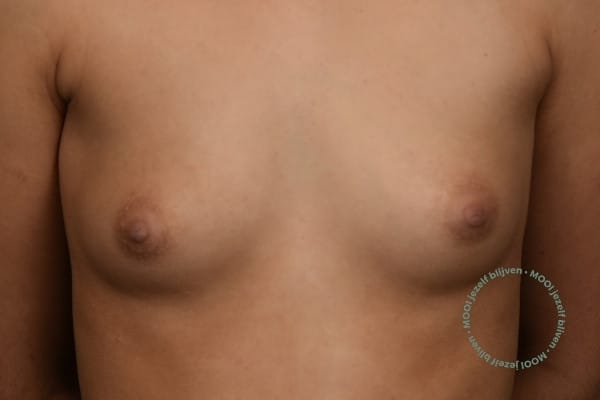 borstvergroting cup A