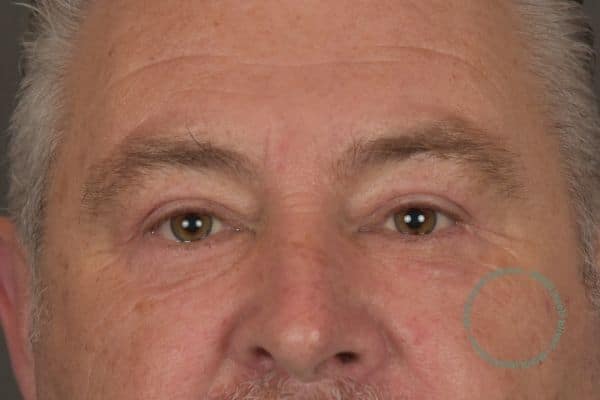 bovenooglidcorrectie fotos