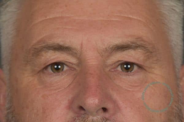 bovenooglidcorrectie kliniek