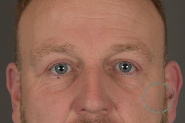 bovenooglidcorrectie resultaat