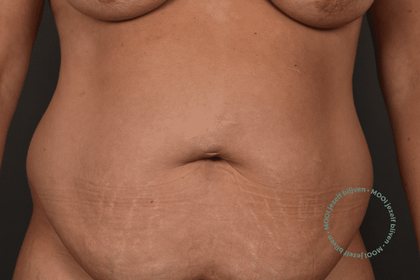 buikwandcorrectie voor foto