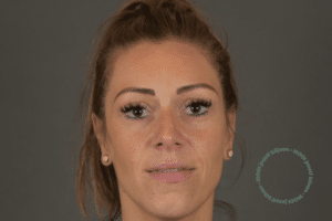 flaporen correctie foto