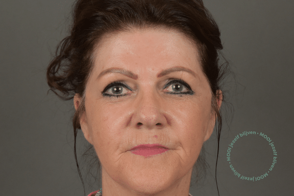 gezicht lipofilling foto