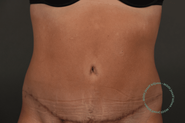 litteken buikwandcorrectie