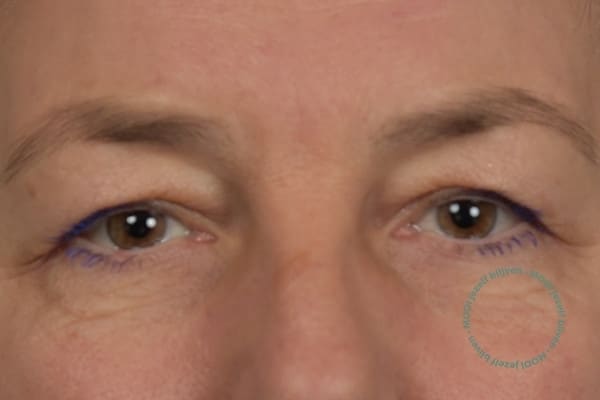 ooglidcorrectie mooi kliniek