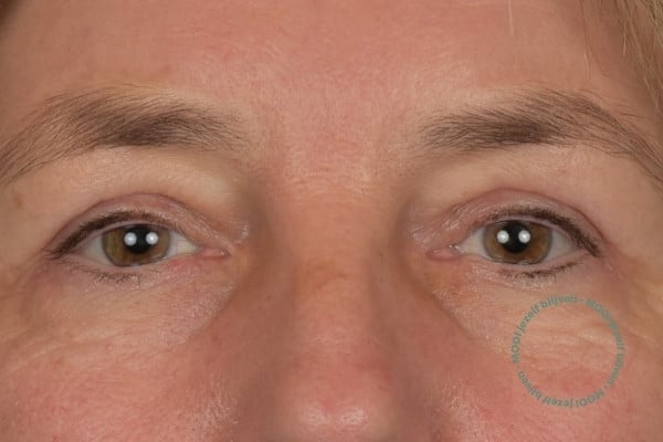 ooglidcorrectie vrouw