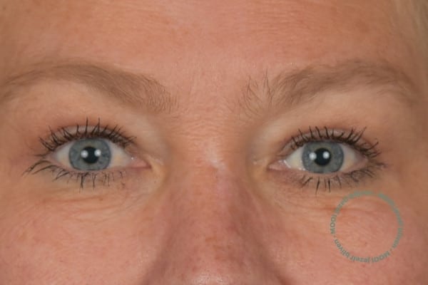 ooglift voor en na foto