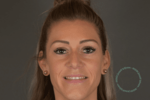 oorcorrectie voor en na foto