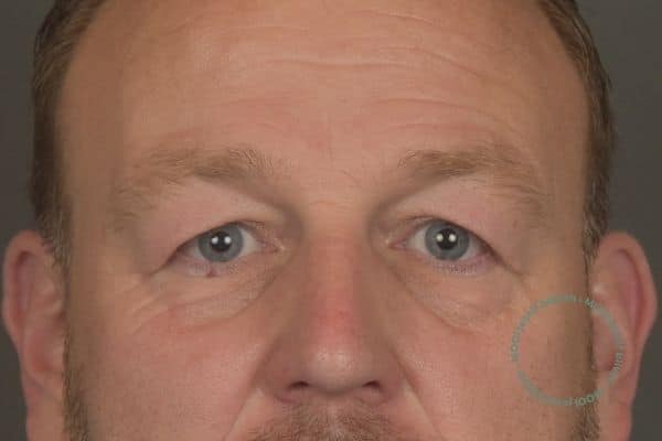 voor bovenooglidcorrectie