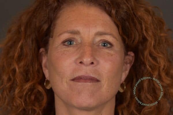 lipofilling gezicht foto voor en na