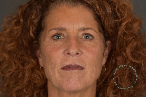 natuurlijke fillers gezicht