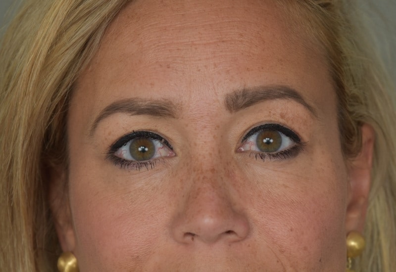 resultaat ooglidcorrectie nadiah