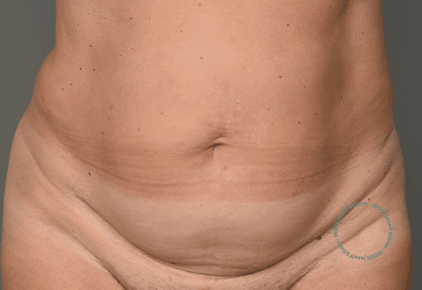 buikspieren diastase operatie