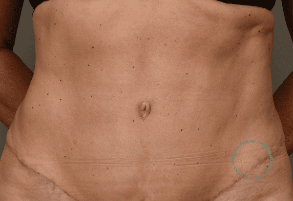 buikwandcorrectie met liposuctie