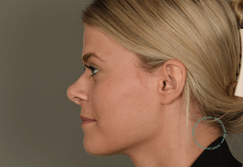 neuscorrectie na foto