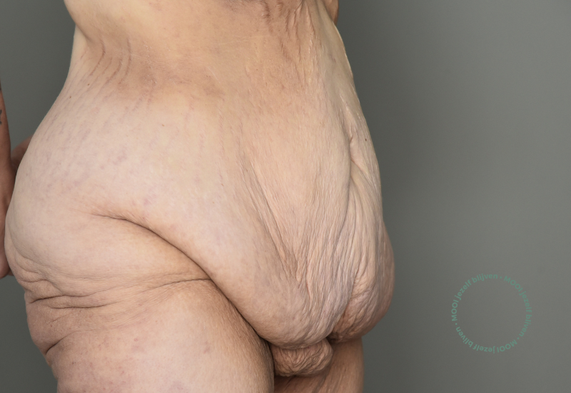 lower body lift voor foto