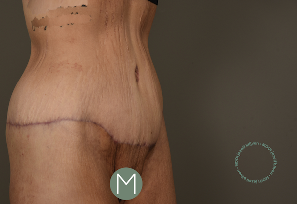 lower body lift foto