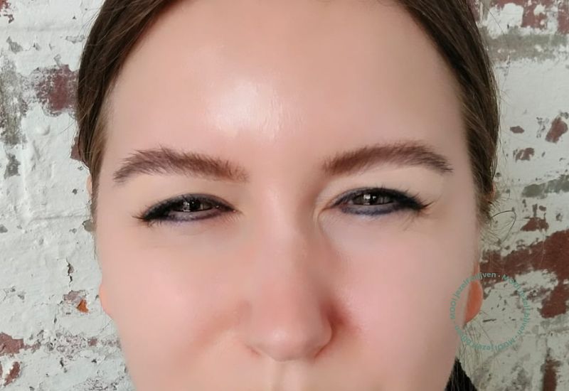 botox fronsrimpel