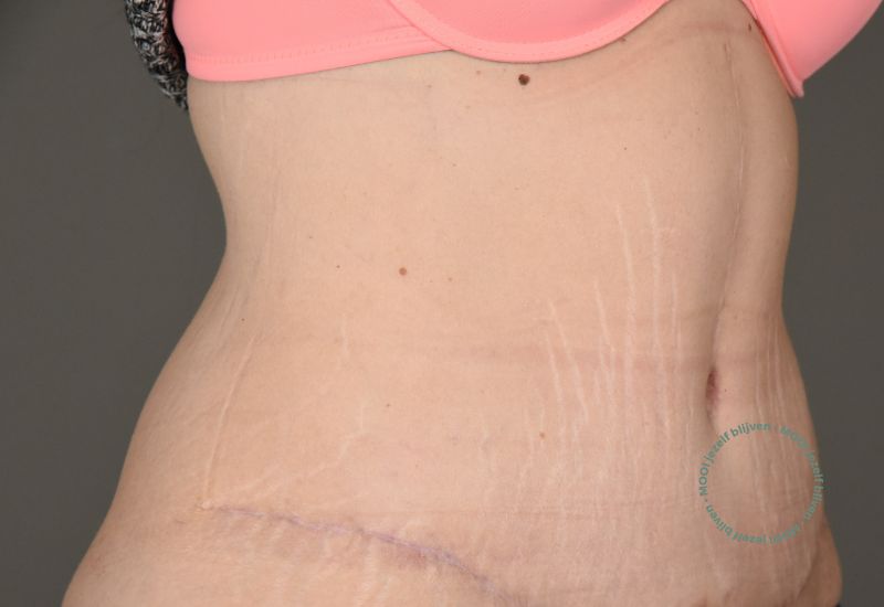 na buikwandcorrectie