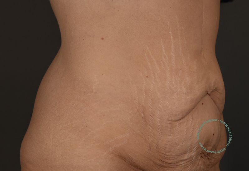 slappe buik buikwandcorrectie