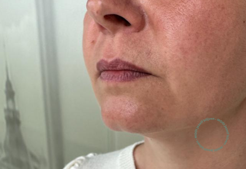 lippen laten opvullen