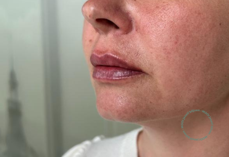 resultaat lipfillers