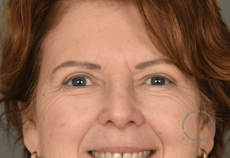 voor foto ooglidcorrectie boven