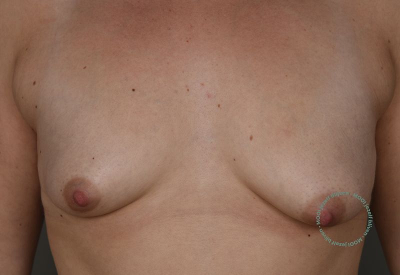 borstvergroting van A naar D