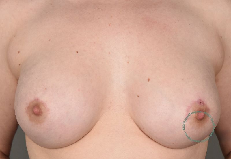 borstvergroting van A naar D cup