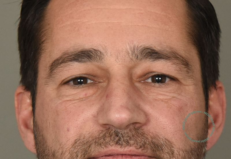 boven en onderooglidcorrectie