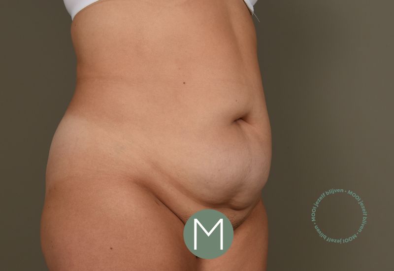buikwandcorrectie met liposuctie